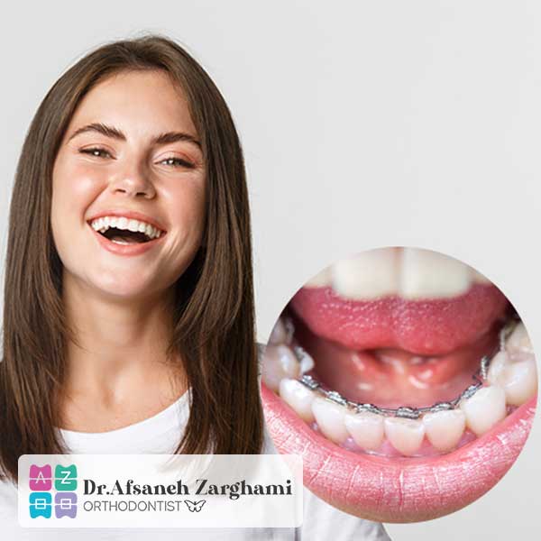 ارتودنسی لینگوال در تبریز